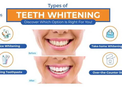 Types of Teeth Whitening in Lake Worth, FL